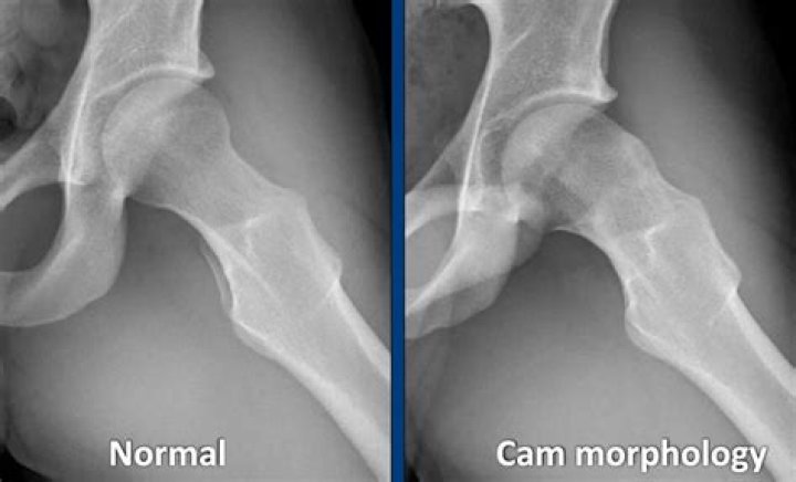 What is a cam deformity of the hip?