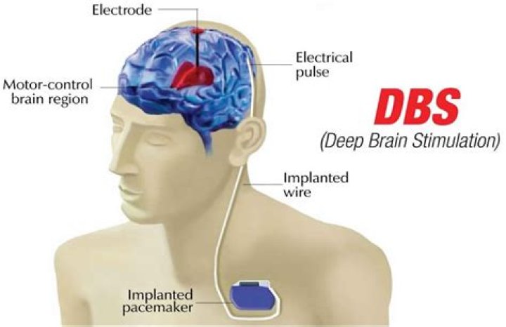 What is a deep brain stimulator?