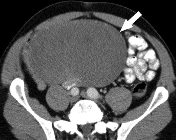 What is a desmoid tumor?