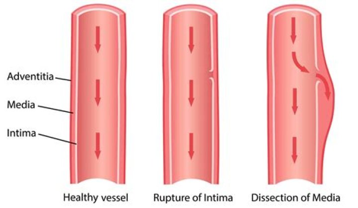 What is a dissecting aneurysm?