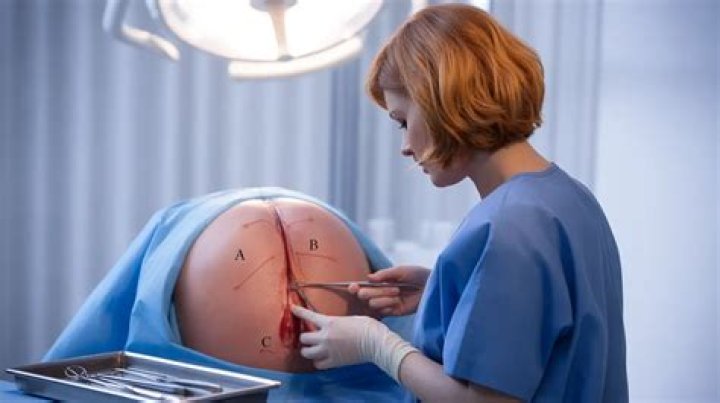 What is a episiotomy?