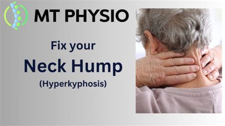 What is a hump on your back?