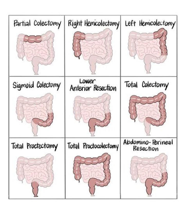 What is a looped colon?