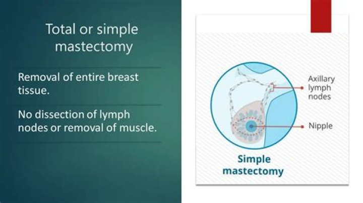 What is a mastectomy in medical terms?