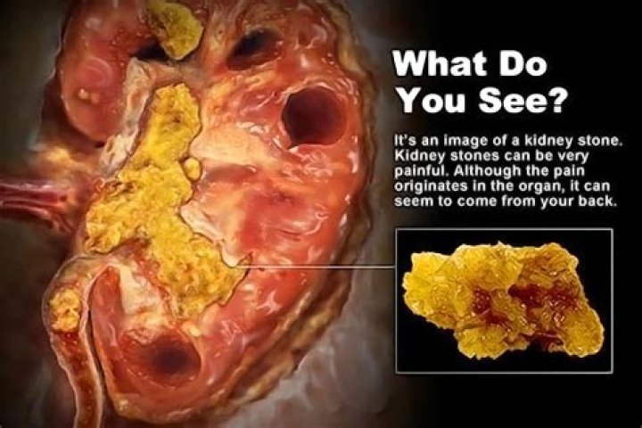 What is a silent kidney stone?