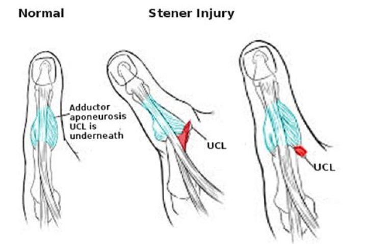 What is a stener lesion of thumb?