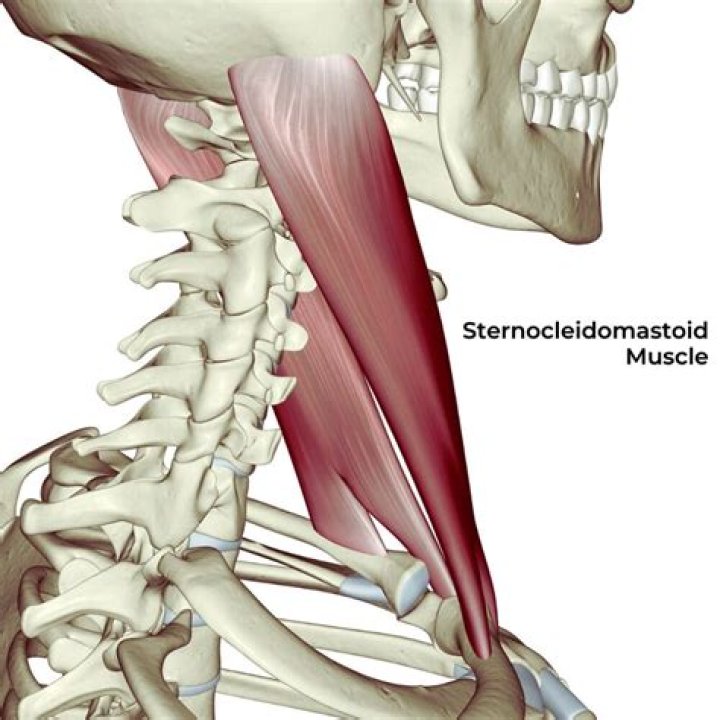 What is a sternomastoid tumour?