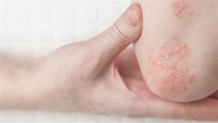 What is an example of a keratolytic that is used to treat psoriasis?