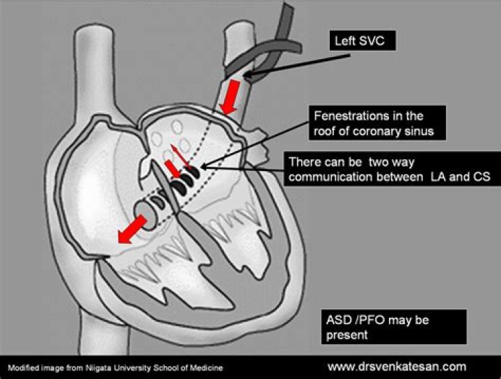 What is an unroofed coronary sinus?