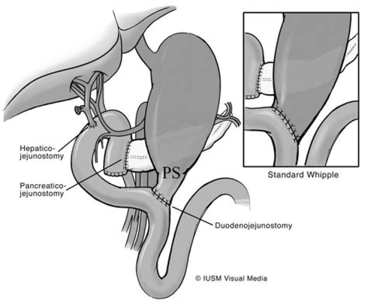 What is antecolic isoperistaltic gastrojejunostomy?