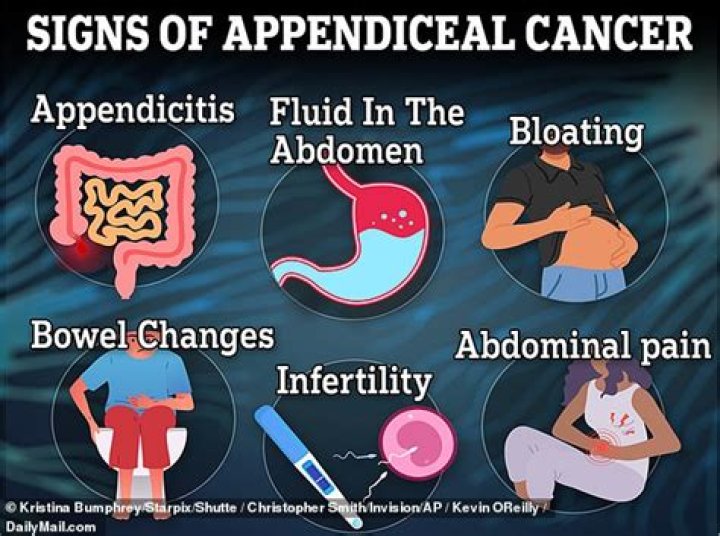 What is appendiceal cancer?