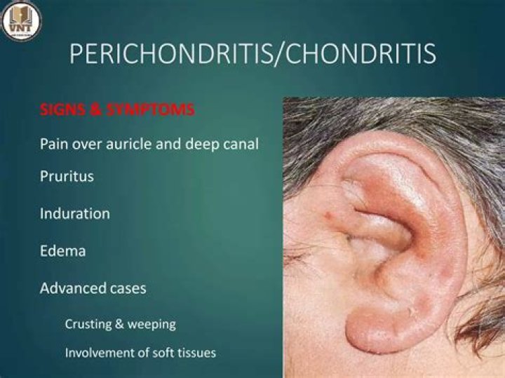 What is auricular perichondritis?