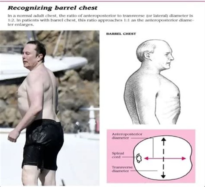What is barrel shaped chest?