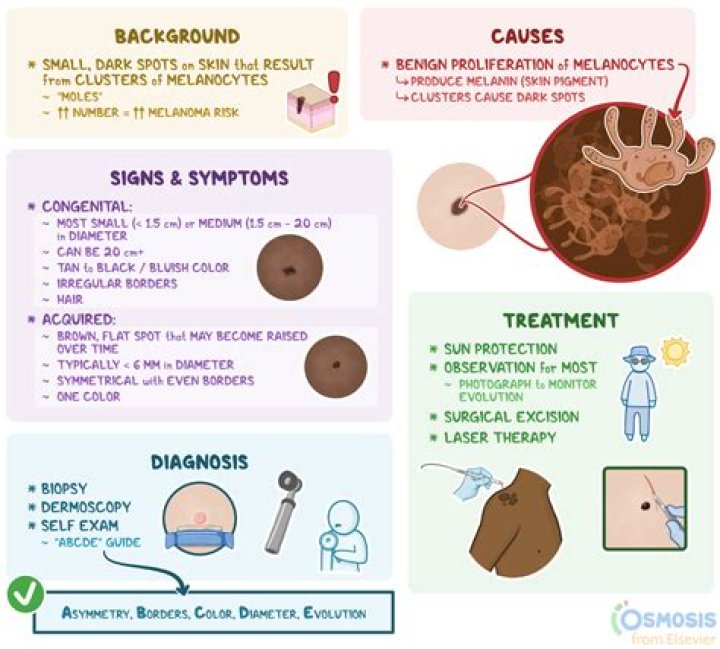What is benign nevi?