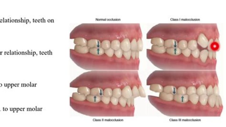 What is class 1 malocclusion?