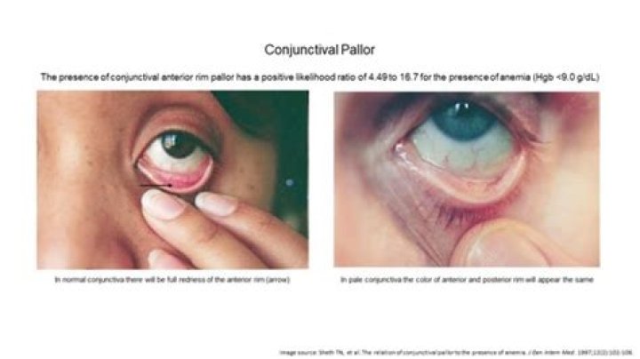What is conjunctival pallor?