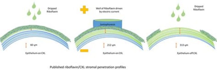 What is corneal cross linking?