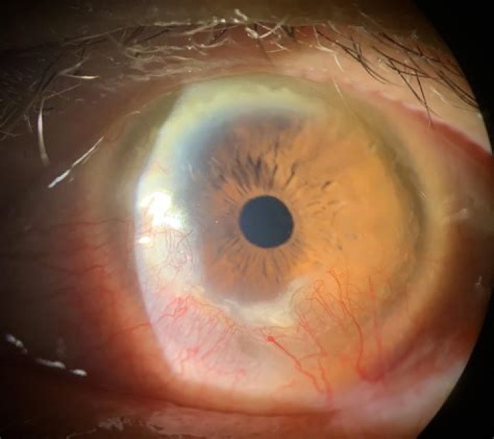 What is corneal pannus?