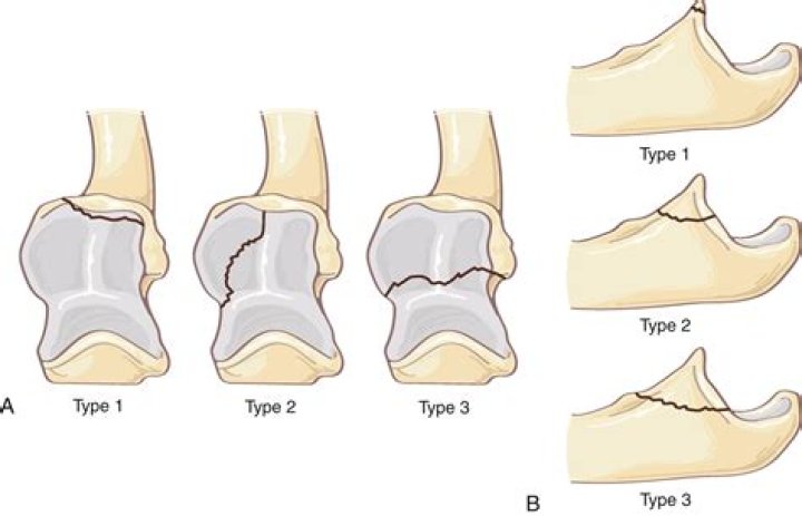 What is coronoid fracture?