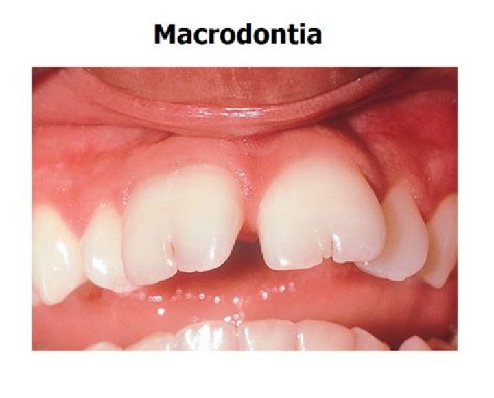 What is dental macrodontia?