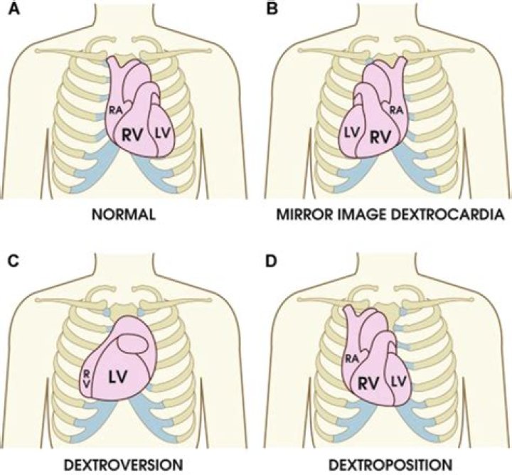 What is dextrocardia situs inversus?
