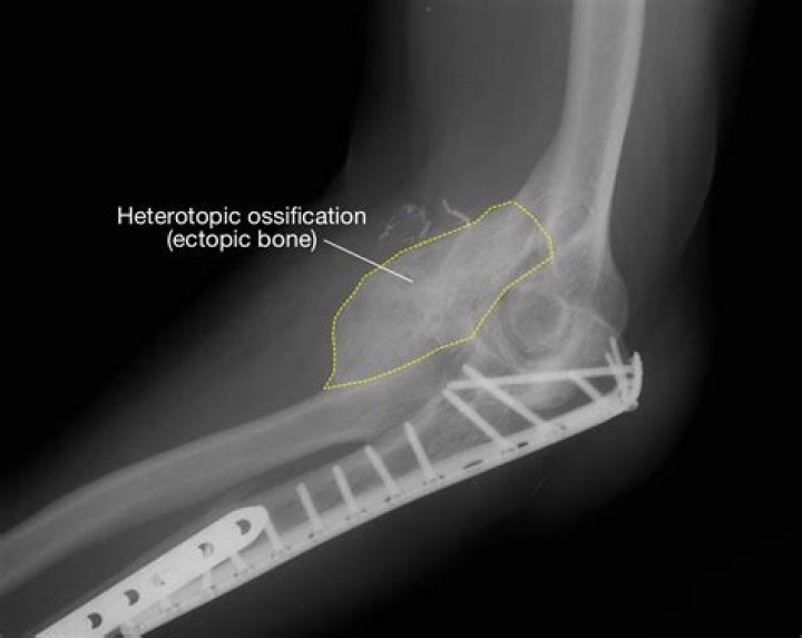 What is heterotopic ossification elbow?