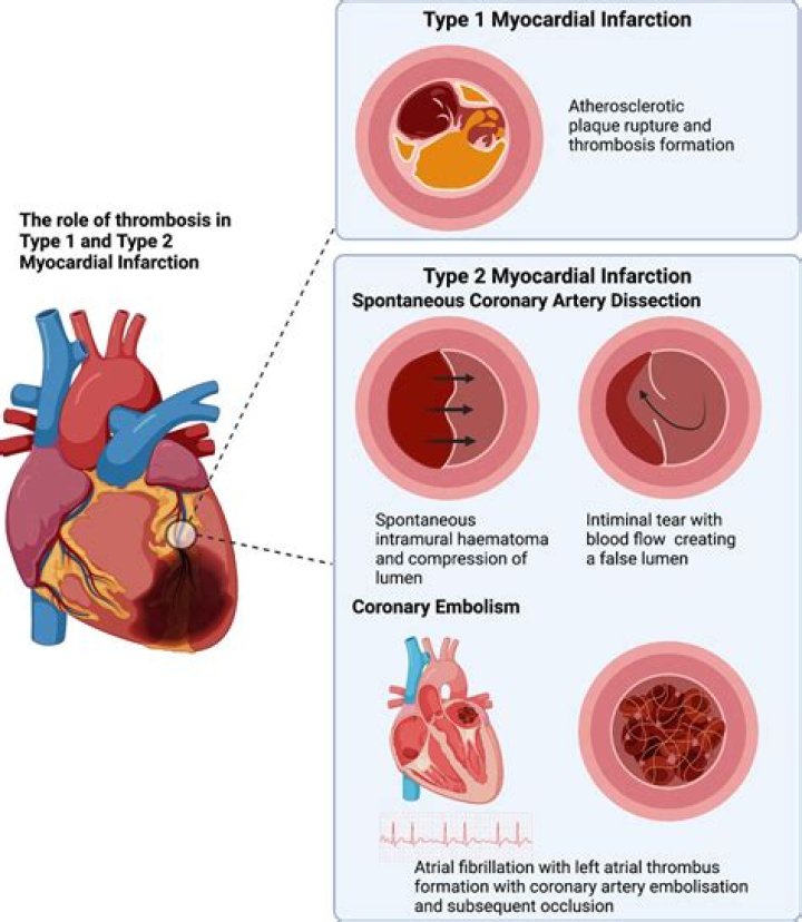 What is intracardiac thrombosis?