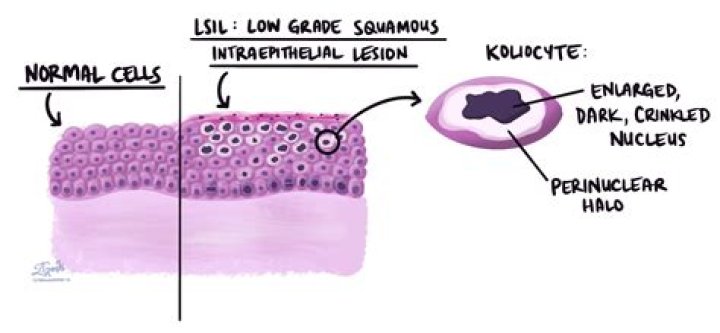 What is intraepithelial eosinophils?