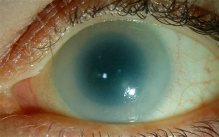 What is intumescent cataract?