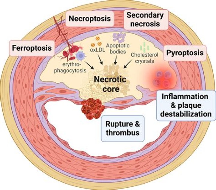 What is meant by arterial necrosis?