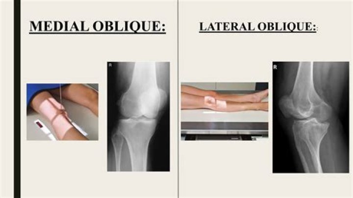 What is mediolateral oblique?