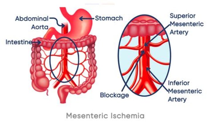 What is mesenteric cancer?