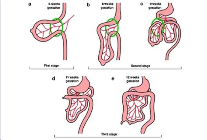 What is midgut malrotation?
