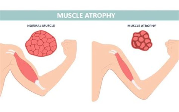 What is muscle wasting?