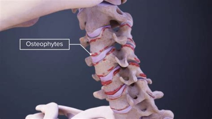 What is osteophytes of the lumbar spine?