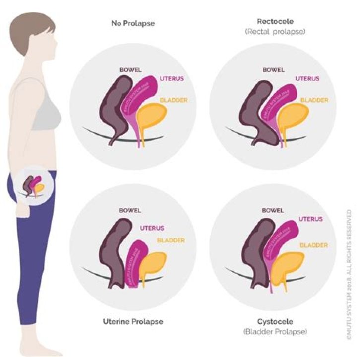 What is pelvic organ prolapse?