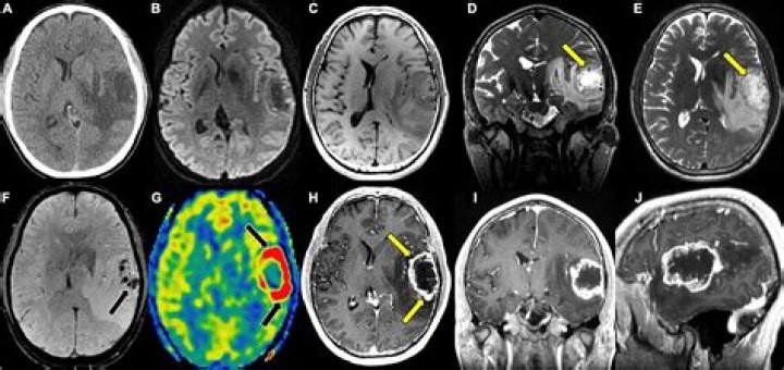 What is radionecrosis brain?