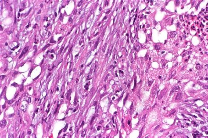 What is sarcomatoid mesothelioma?
