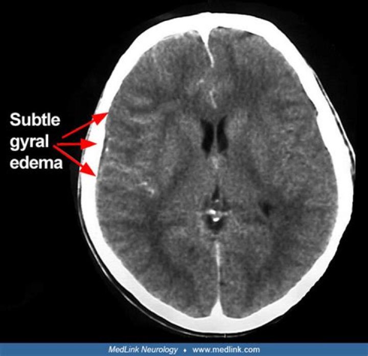 What is subdural empyema?