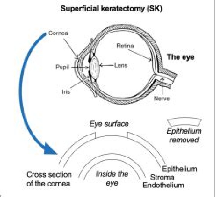 What is superficial keratectomy?