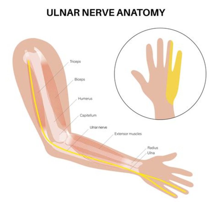 What is tardy ulnar nerve palsy?