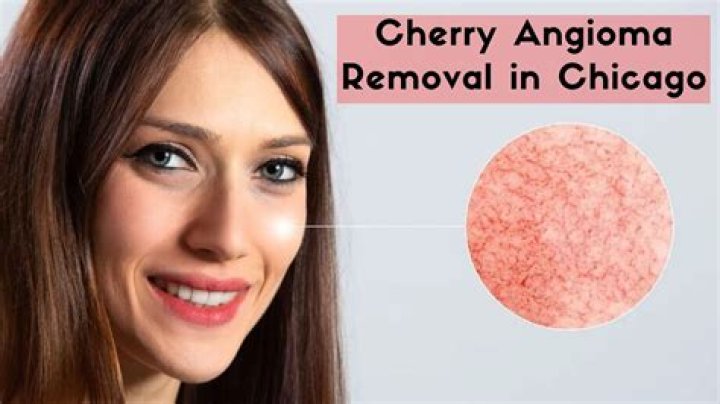 What is the best way to remove cherry angiomas?