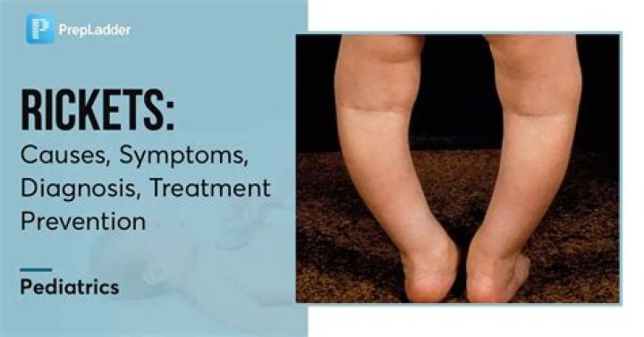 What is the medical definition for rachitis?