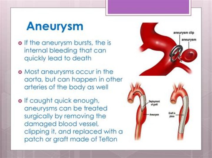 What is the most common cause of aneurysm?