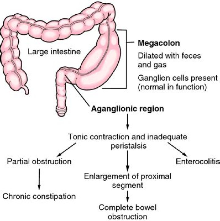 What is the pathophysiology of aganglionic megacolon?