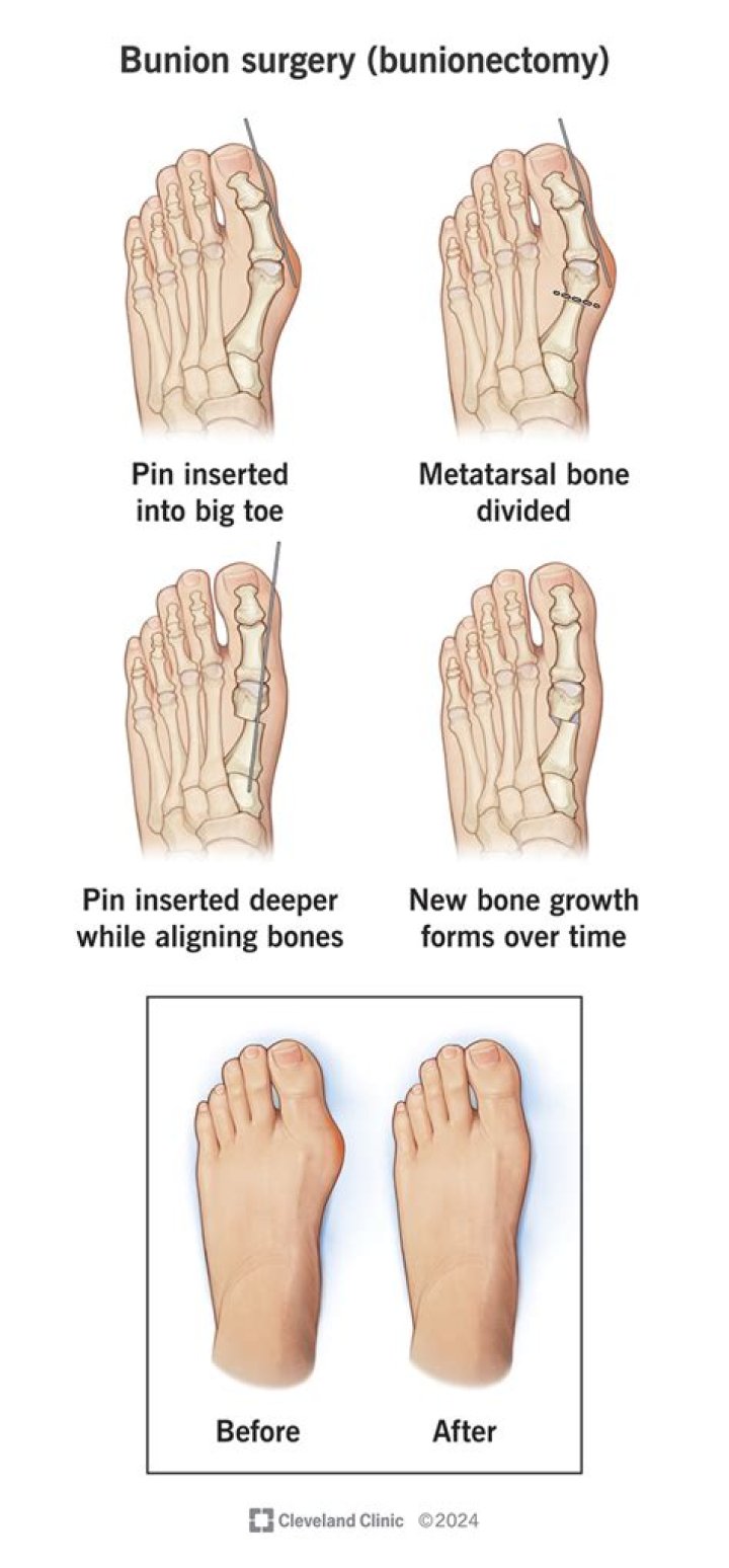 What is the recovery time for bunion and hammertoe surgery?