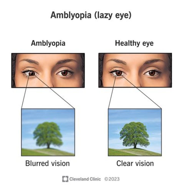 What is the treatment for amblyopia?