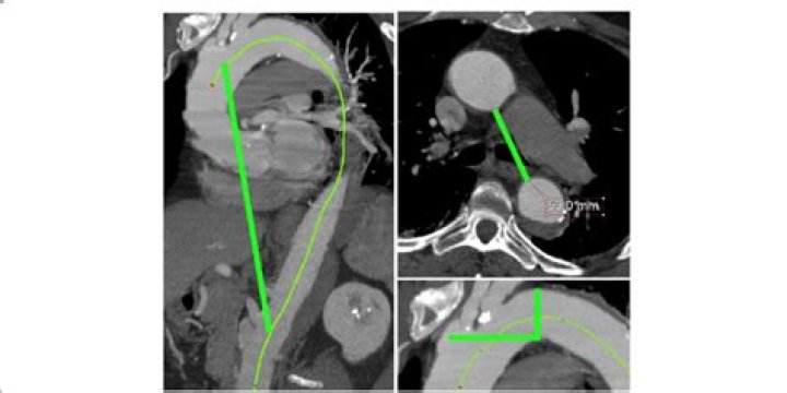 What is tortuosity of the thoracic aorta?
