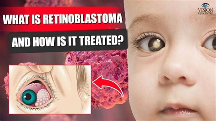 What is trilateral retinoblastoma?