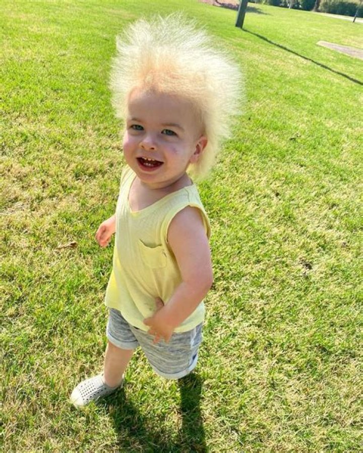 What is uncombable hair syndrome?